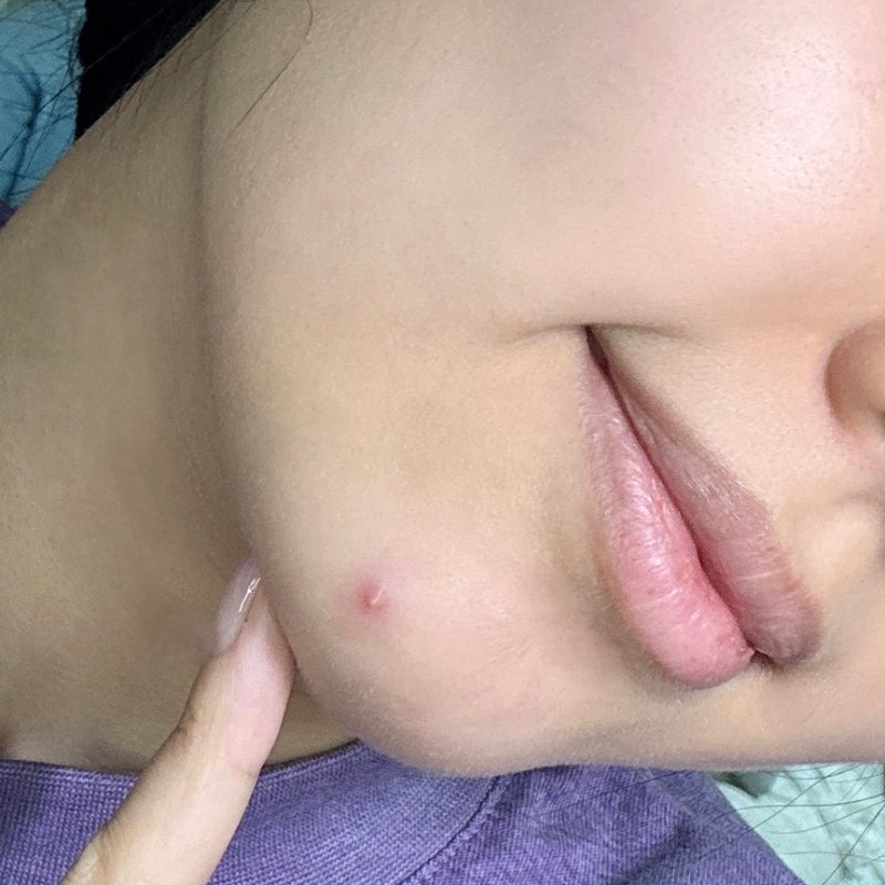 턱밑에 딱딱한 여드름 염증주사 후기 (빠르게 없애는법)