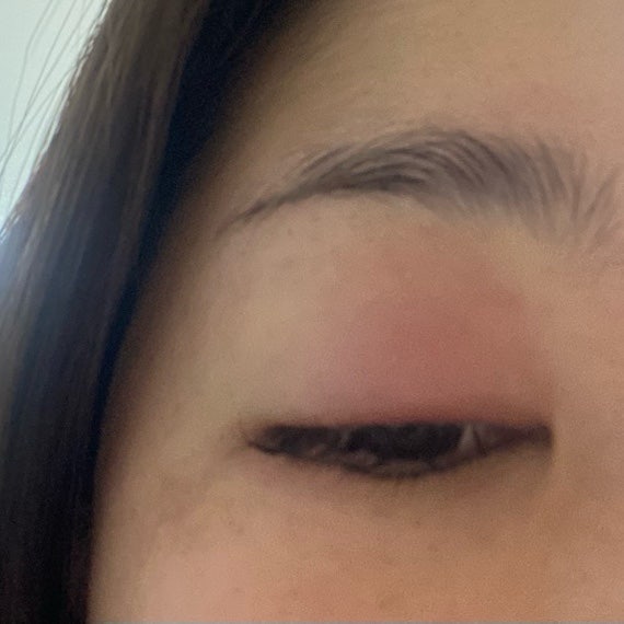 콩 다래끼 자연치유 방법 2년 동안 6번 난 다래끼 없앤 후기