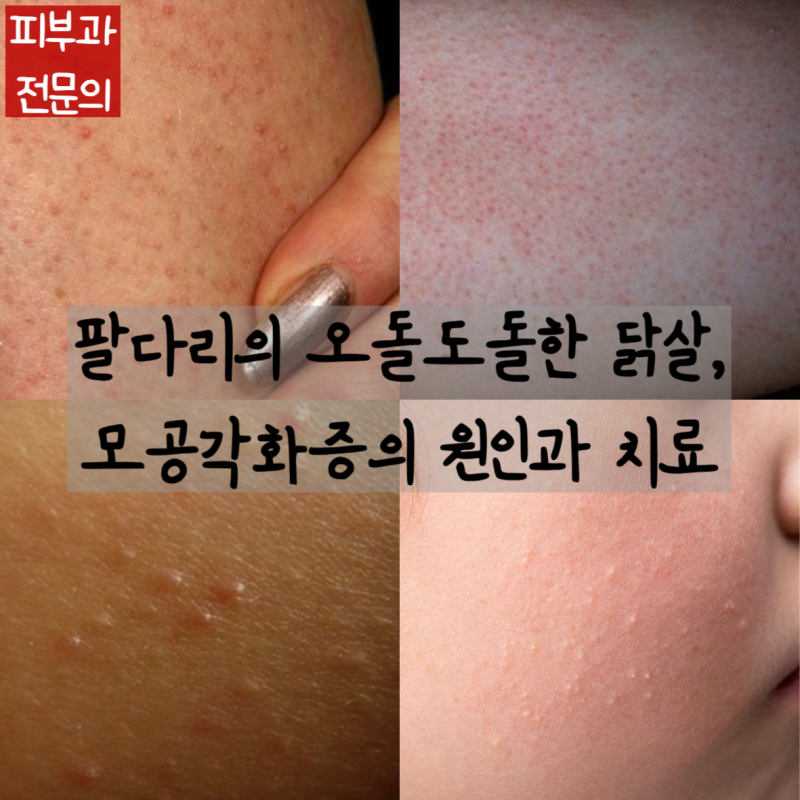 팔·다리의 오돌토돌 닭살, 모공각화증의 원인과 올바른 치료법