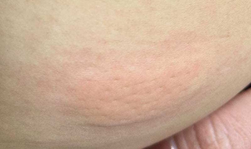 마운자로 부작용 근육통 두통 몸살, 며칠이면 괜찮아질까 총정리