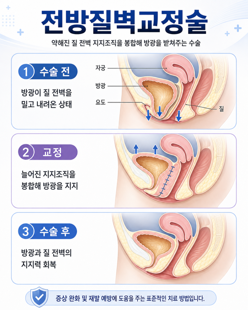 방광이 몸 밖으로 탈출?! 방광류 수술방법 '전방질벽교정술'과 구체적 원인·치료 원리를 명....