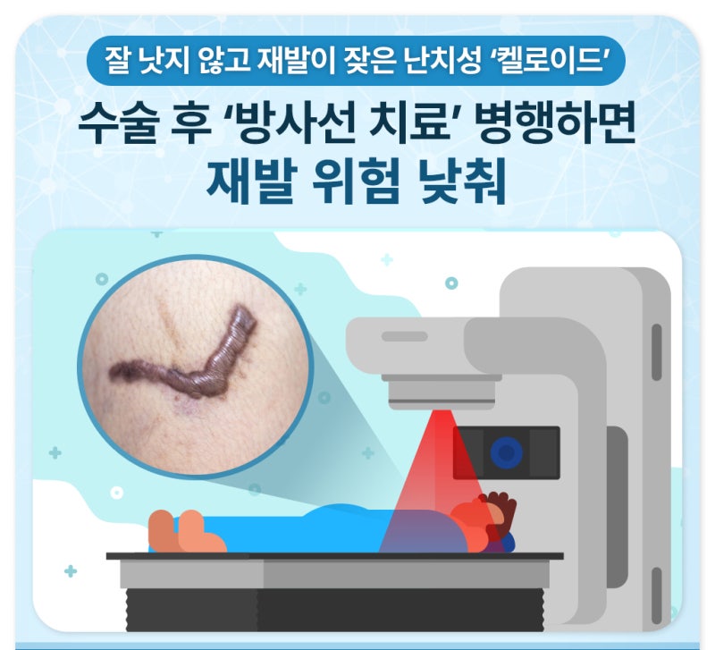 잘 낫지 않고 재발이 잦은 난치성 ‘켈로이드’ 수술 후 ‘방사선 치료’ 병행하면 재발 위....