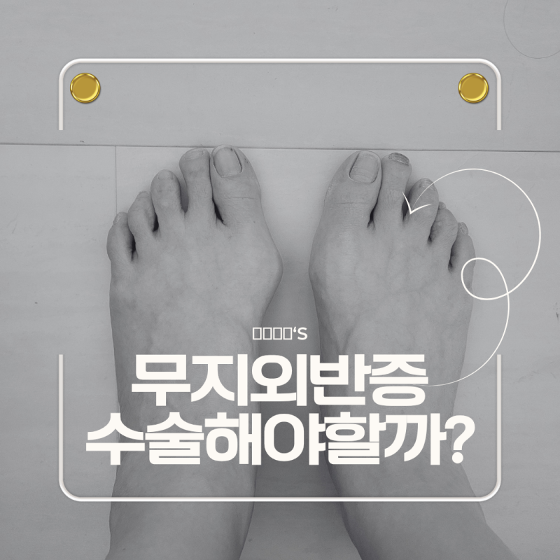 무지외반증 수술, 결국 해야돼요??