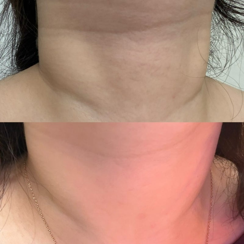 올킨스 실리콘 넥패치 4회 사용후기｜목주름 효과 & 피부반응