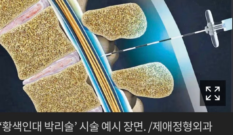 척추관 협착증 시술