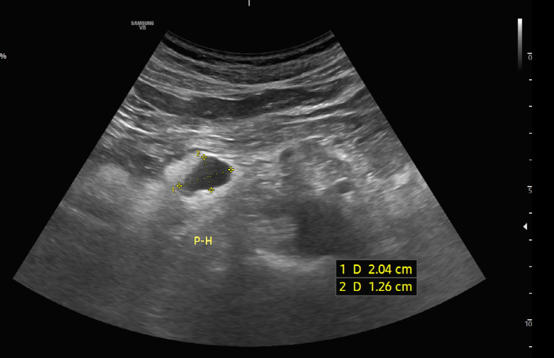 건강검진 중 발견된 췌장낭종, 췌장 낭종 - 복부 초음파와 MRI 어떤게 좋은가요?