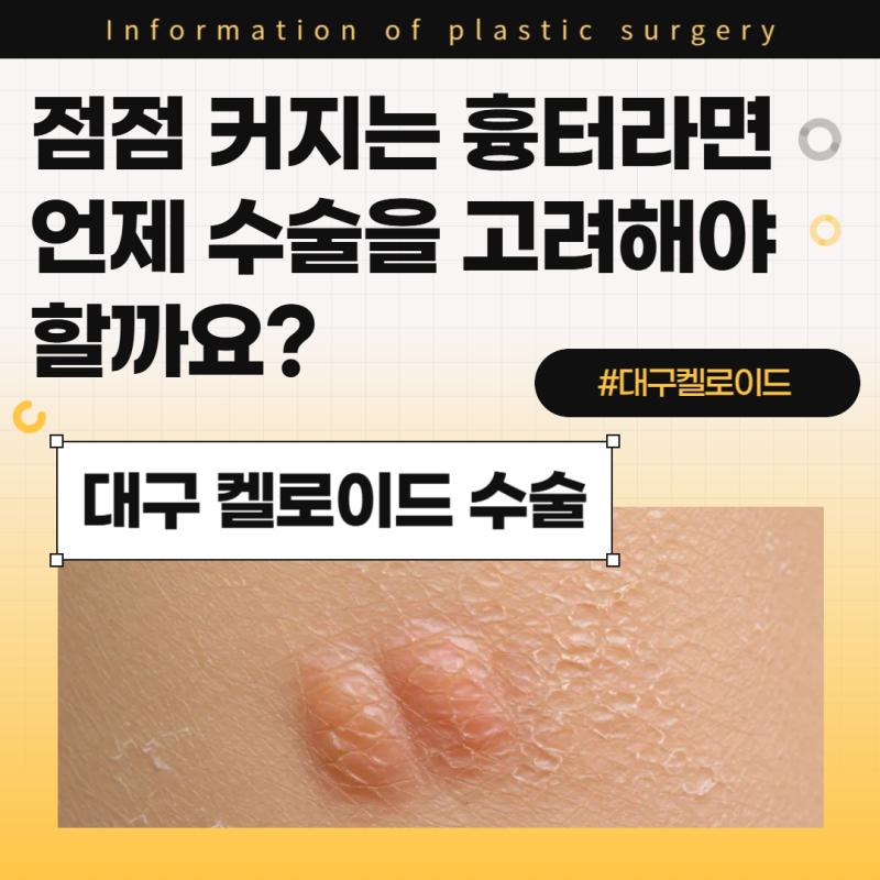 대구 켈로이드, 점점 커지는 흉터라면 언제 수술을 고려해야 할까요?