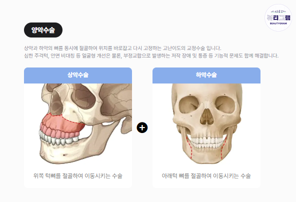 윤곽수술 양악수술 전후 차이