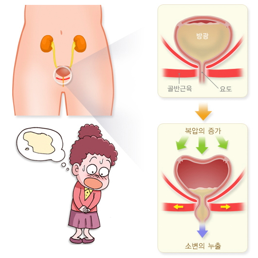복압성 요실금, 과민성 방광 차이, 새는 것과 다급함은 달라요.