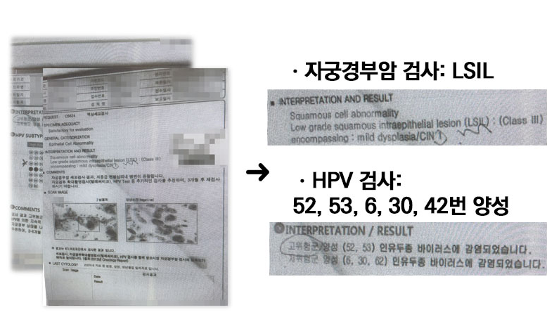 자궁경부이형성증 임신 중 발견됐다면 이렇게 하세요