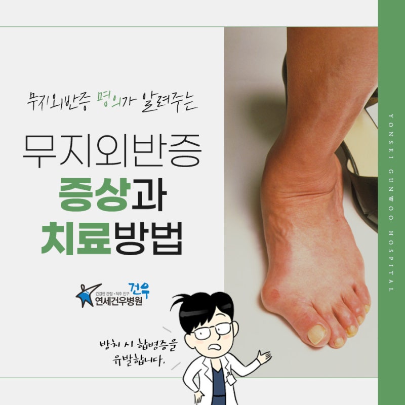 무지외반증 단계별 증상 확인 및 치료 방법 (합병증)