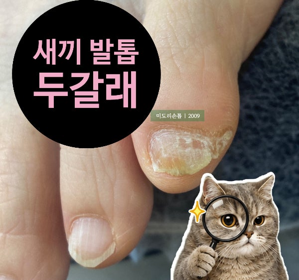 새끼발톱이 자꾸 갈라지고 양말에 걸리는 이유