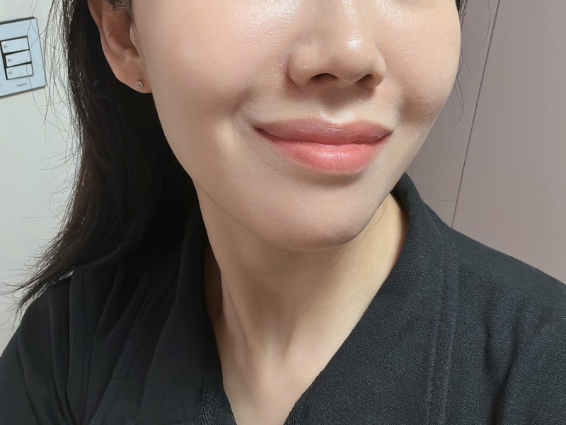 팔자주름 시술 추천 필러 비교 후 콜라겐부스터 스컬트라 후기