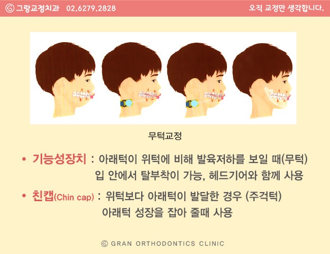 초등학생 치아교정 시작 시기 및 비용