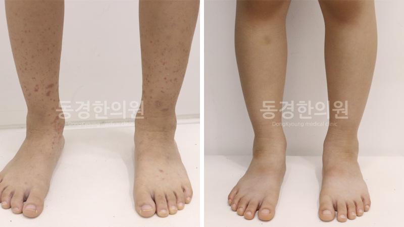 모세 혈관염 자반증인지 궁금하다면? 색소성 자반증 증상 알아보기