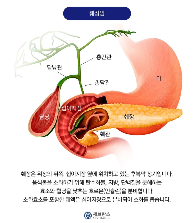 췌장암 증상 이렇게 나타납니다 / 체중 감소·등 통증·황달을 주목하세요