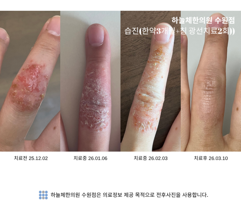 손습진이 자꾸 재발하는 이유, 단순히 연고만의 문제일까요?