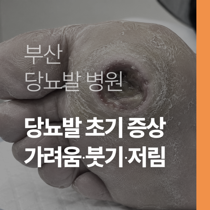 부산 당뇨발 초기 증상은? 가려움 저림 붓기