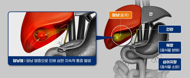 [FAQ] 쓸개 제거 수술 받으면 소화는 잘 될까? 담낭절제술 앞두고 가장 많이 하는 질문 5가지(....