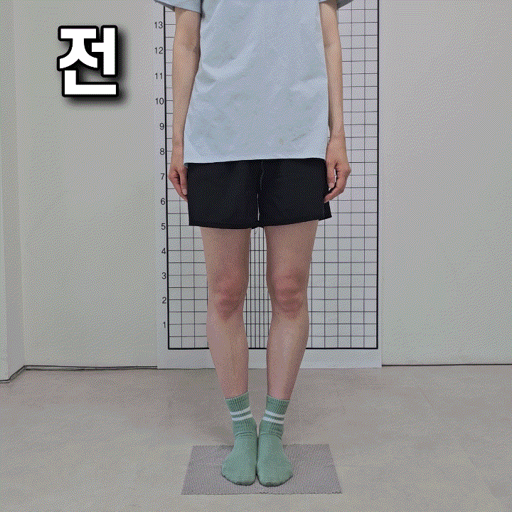 오다리 교정 운동 방법｜무작정 따라 하기 전에 꼭 확인하세요