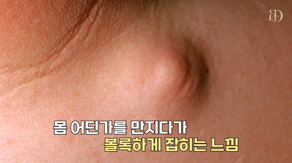 서초구피부과, 몸에 생긴 볼록한 혹? 지방종과 표피낭종 차이점 정리