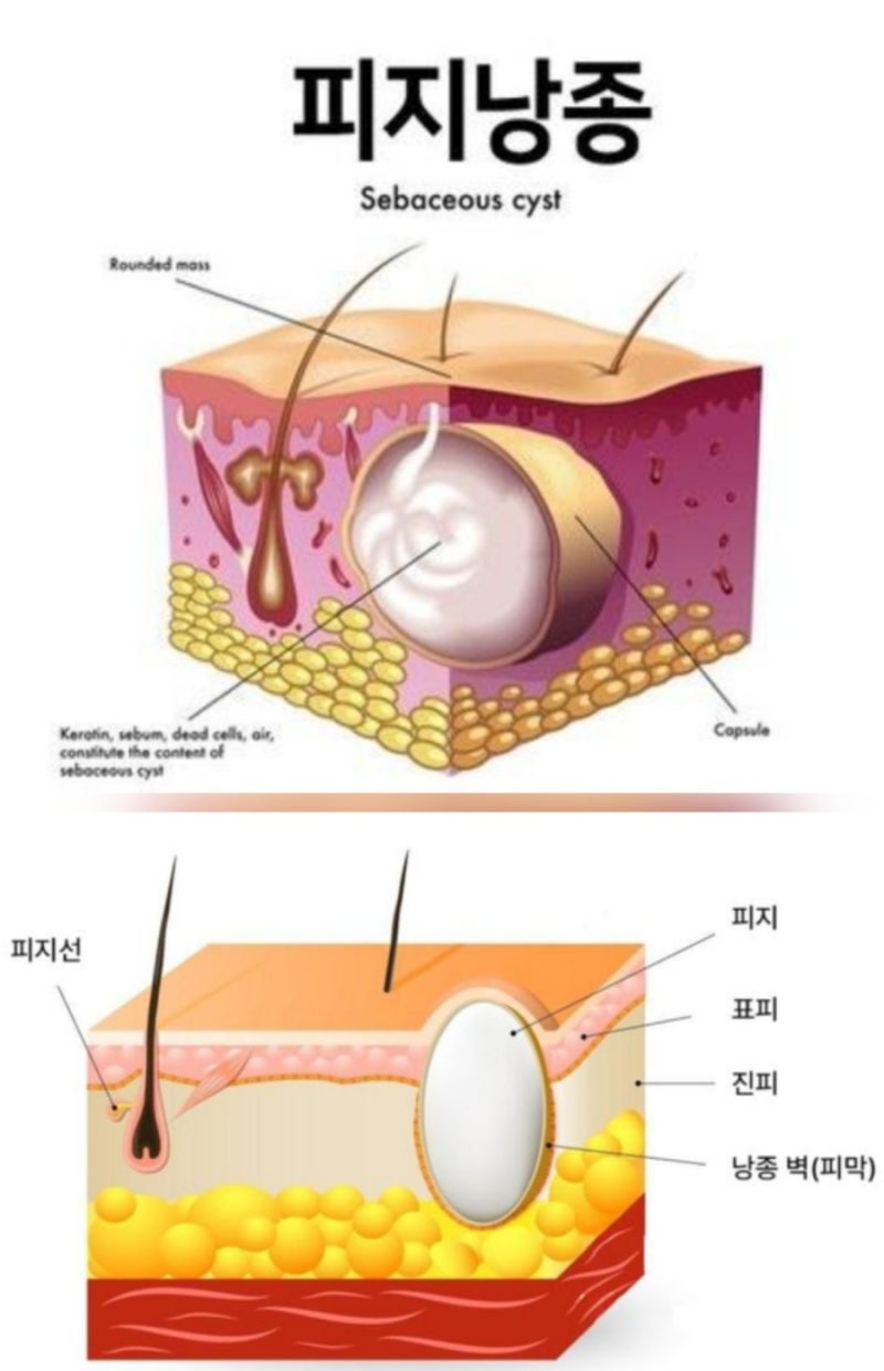 엉덩이에 생긴 피지낭종 제거사례