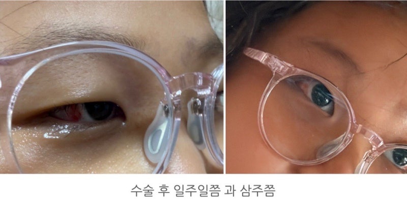 서울아산병원 소아 간헐적 외사시 수술 한달 후기｜복시·충혈 한달차 진료 결과