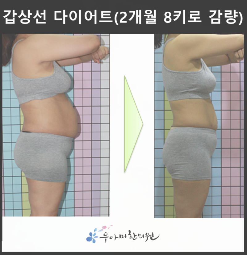 갑상선암 다이어트의 체중 정체, 먹는 양만으로 계산되지 않습니다