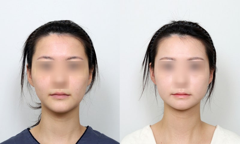 주걱턱교정 윤곽수술 전후 : 사각턱수술 & 턱끝수술(돌려깎기)