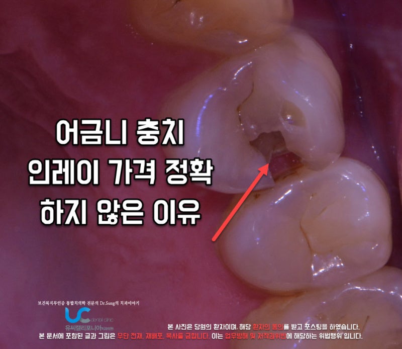 어금니 충치 인레이 가격 정확 하지 않은 이유는?