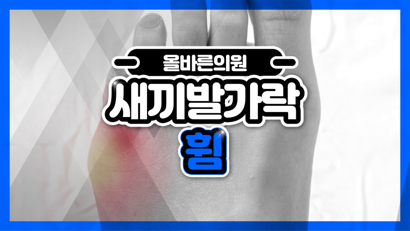 새끼발가락 굳은살 휨 물집 방치하면 또 다른 관절 문제로