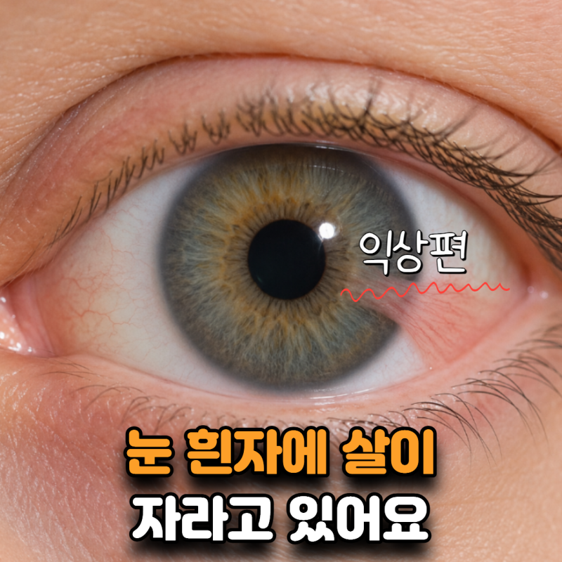 “눈 흰자에 살이 자라왔어요” 익상편 원인, 무조건 수술해야 할까?