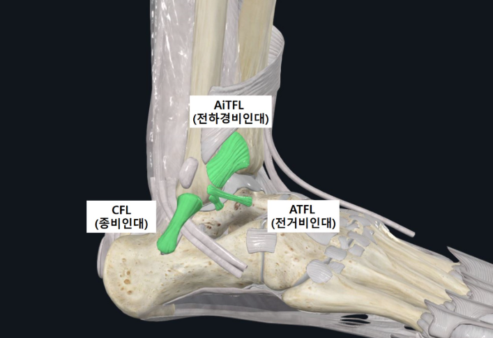 위례 통증 한의원 , 발목삐끗 발목염좌 대처법 치료법