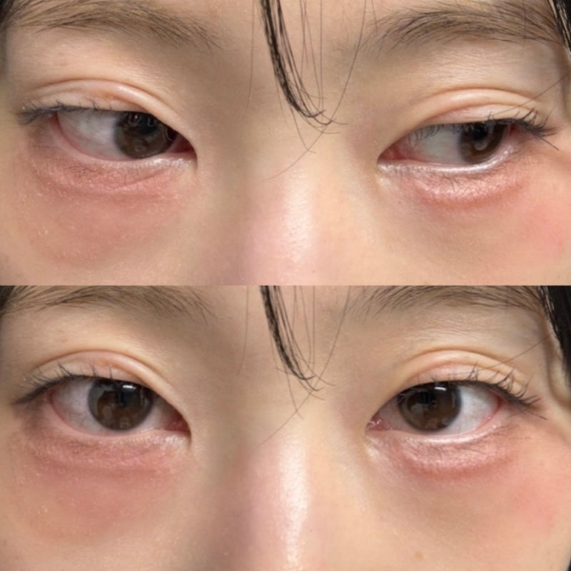 눈가 가려움 따가움 무너진 장벽 디판테놀로 극복하기