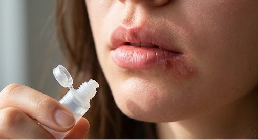 "물집 올라오기 전 찌릿할 때 바르면 손해 안 봅니다" 입술 헤르페스 연고 바르는 시기