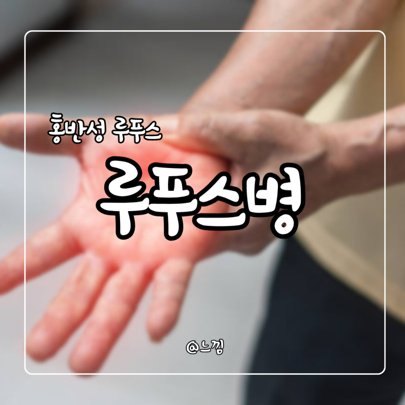 루푸스병 증상 원인 전신 홍반성 루푸스 검사