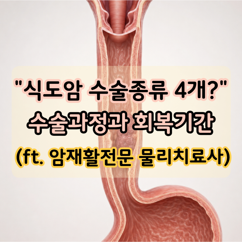 "식도암 수술 종류 4가지?" 수술 과정과 회복기간 정리 (ft. 암재활전문 물리치료사)