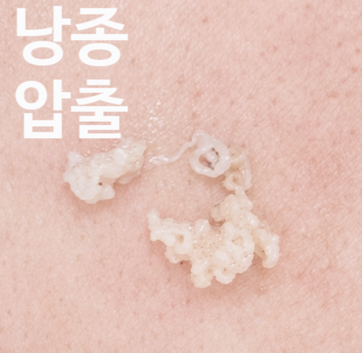 귓볼 피지낭종의 위치가 알려주는 것, 귀걸이 구멍부터 귓불 안쪽까지