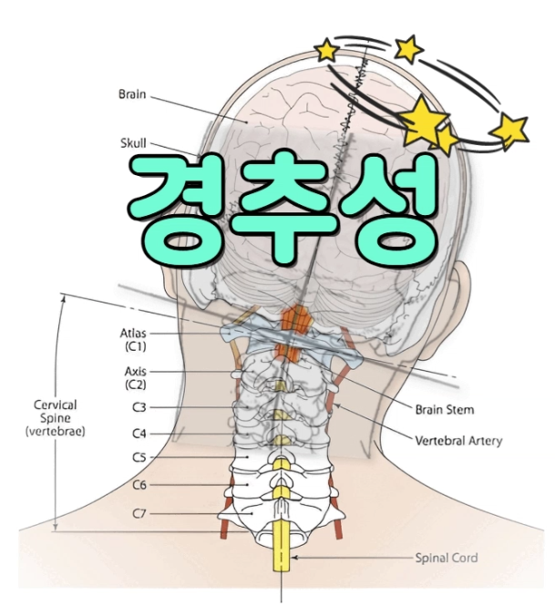 경추성 어지럼증? 그게 진짜 있는 건가요? 어떻게 진단하나요?