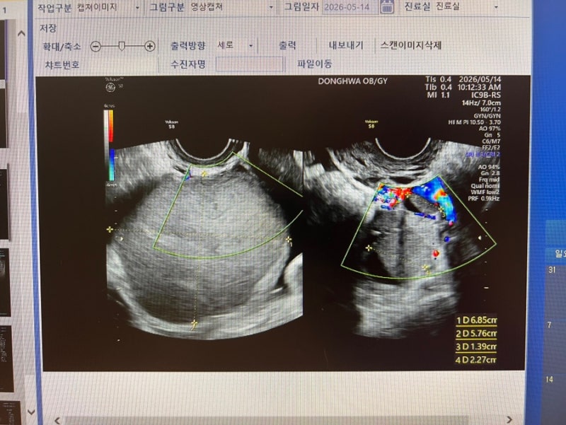 자궁내막증 수술후기(심부자궁내막증, 난소 낭종)
