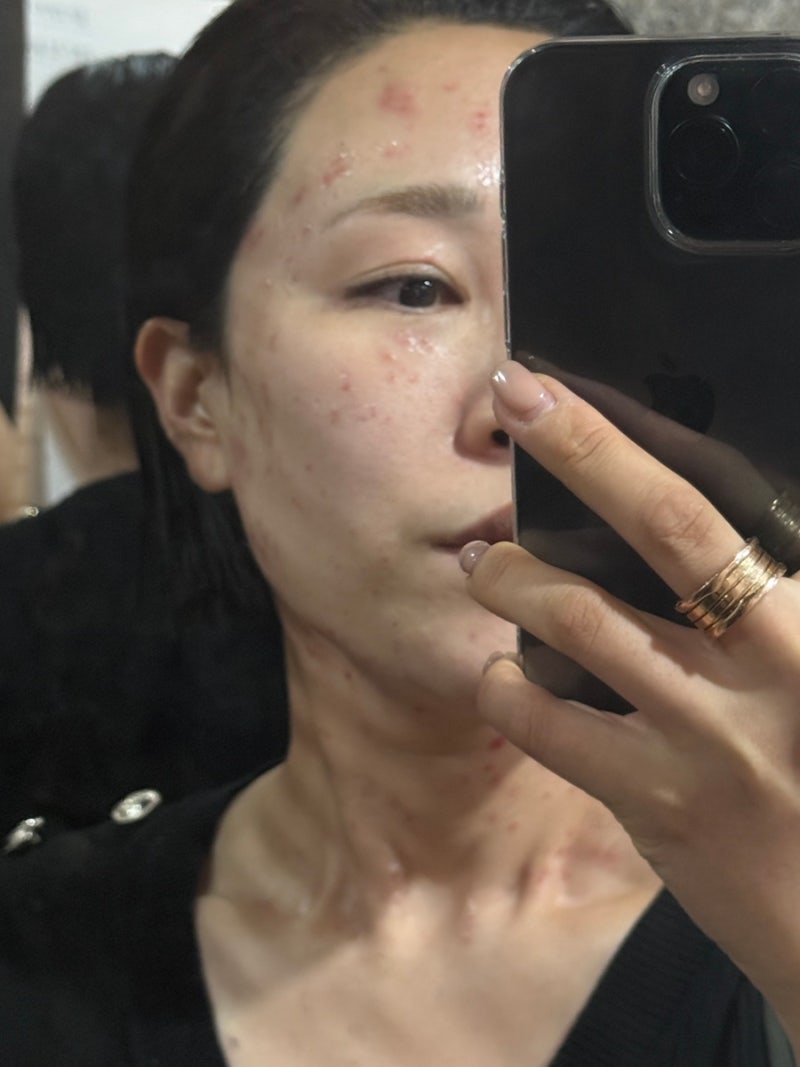 울산 편평사마귀 성지 리터치까지 완벽해