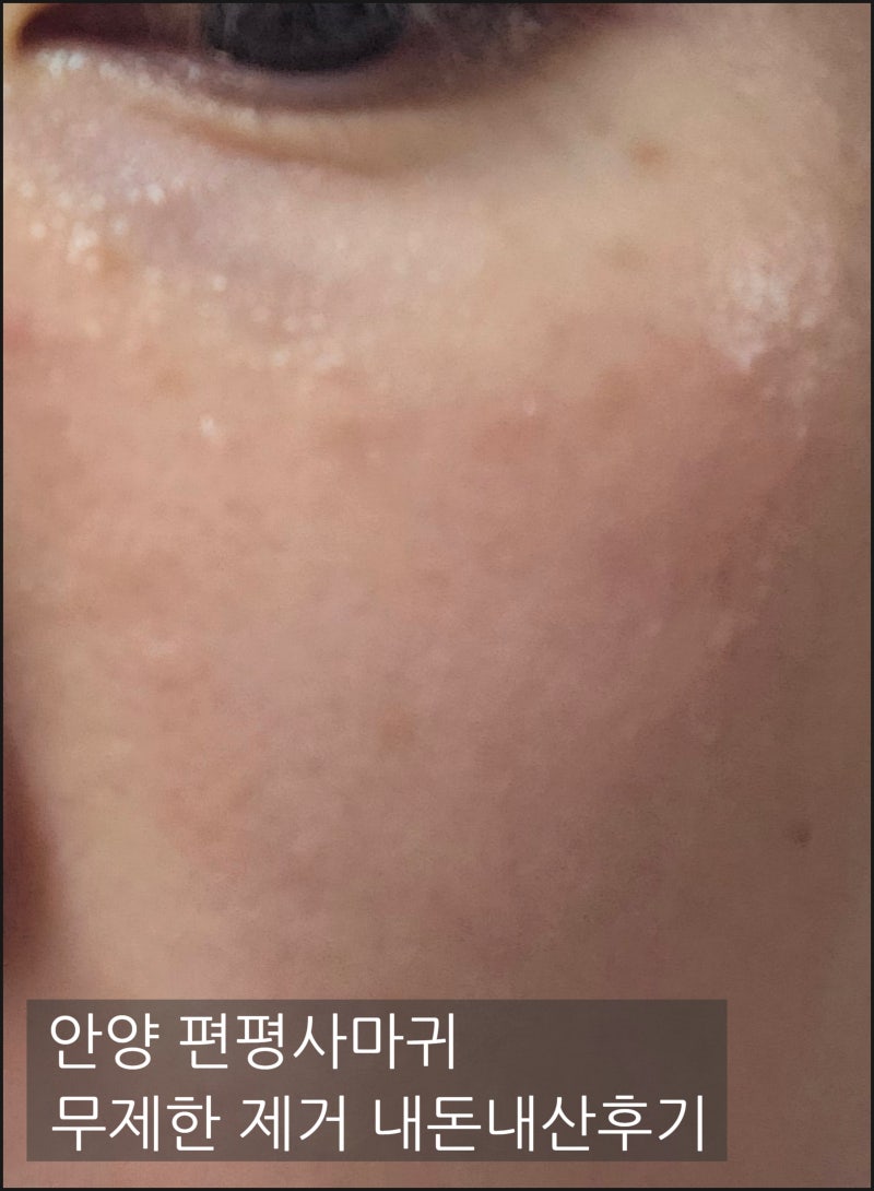 리얼내돈내산 안양 편평사마귀 성지 제거후기 무려200개이상 찐솔직 고통기 시술할인 개꿀팁....
