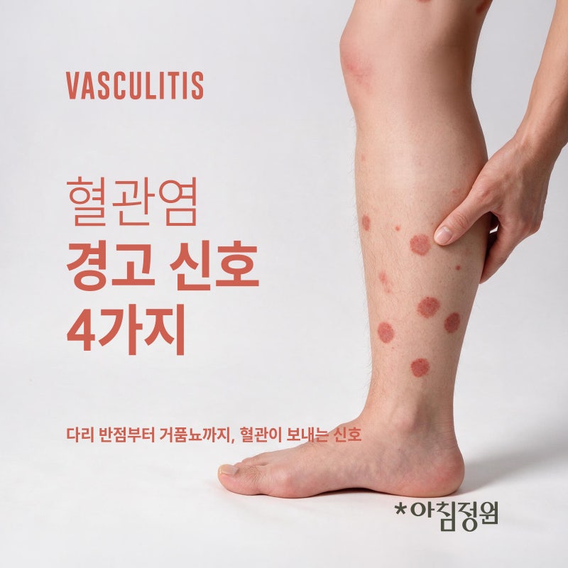 다리에 생긴 붉은 점, 단순 피부병이 아닐 수 있습니다 (혈관염 신호 4가지)