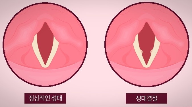 성대결절 치료법