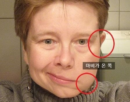 안면마비 물리치료사가 설명하는 연합운동과 구축, 그리고 재활치료