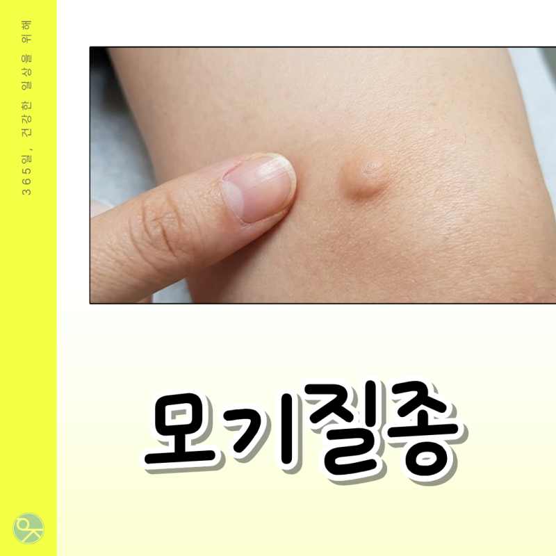 울산 피부아래 혹, 표피낭종인 줄 알았는데 모기질종?