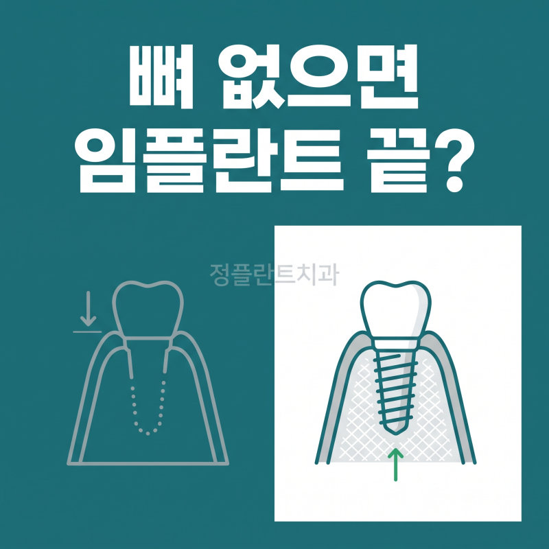 천안아산 임플란트 뼈이식 | 뼈가 부족하면 임플란트 아예 못 하나요?