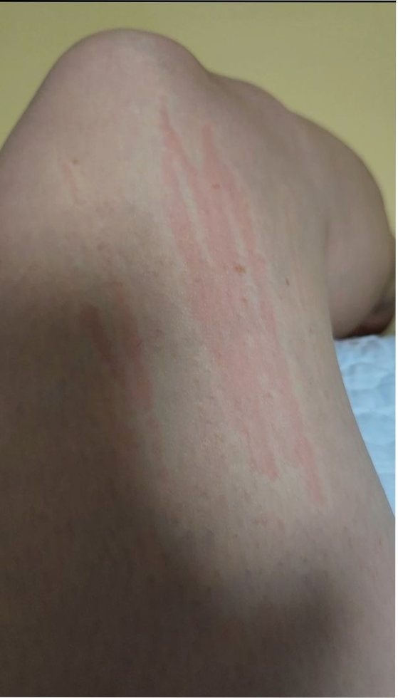 이오시카제모기 사용 후 피부관리