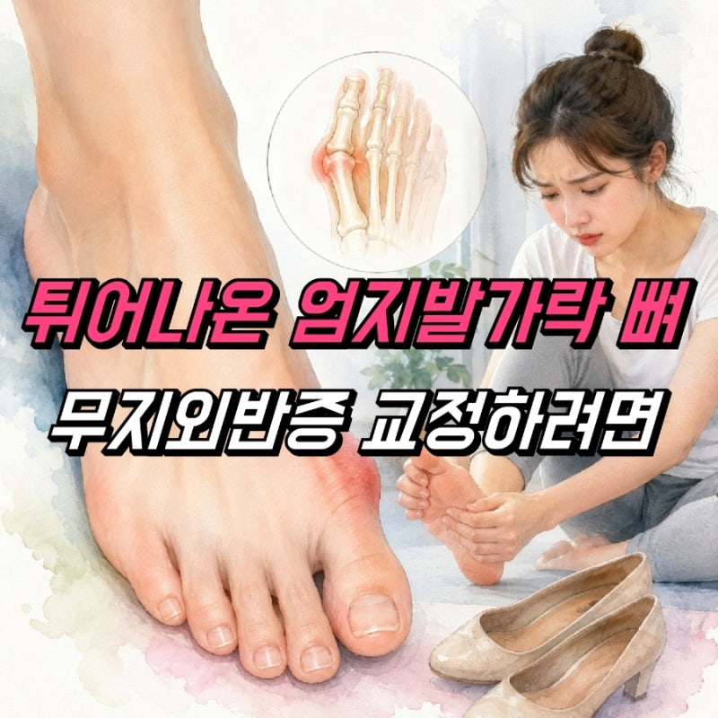 무지외반증 증상 통증 엄지발가락 뼈 돌출 휨, 교정하려면