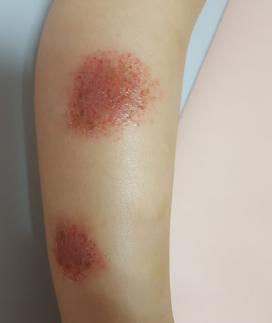 화폐상습진 연고 사용이 부담될 때, 보습제는 어떤 역할을 할까?
